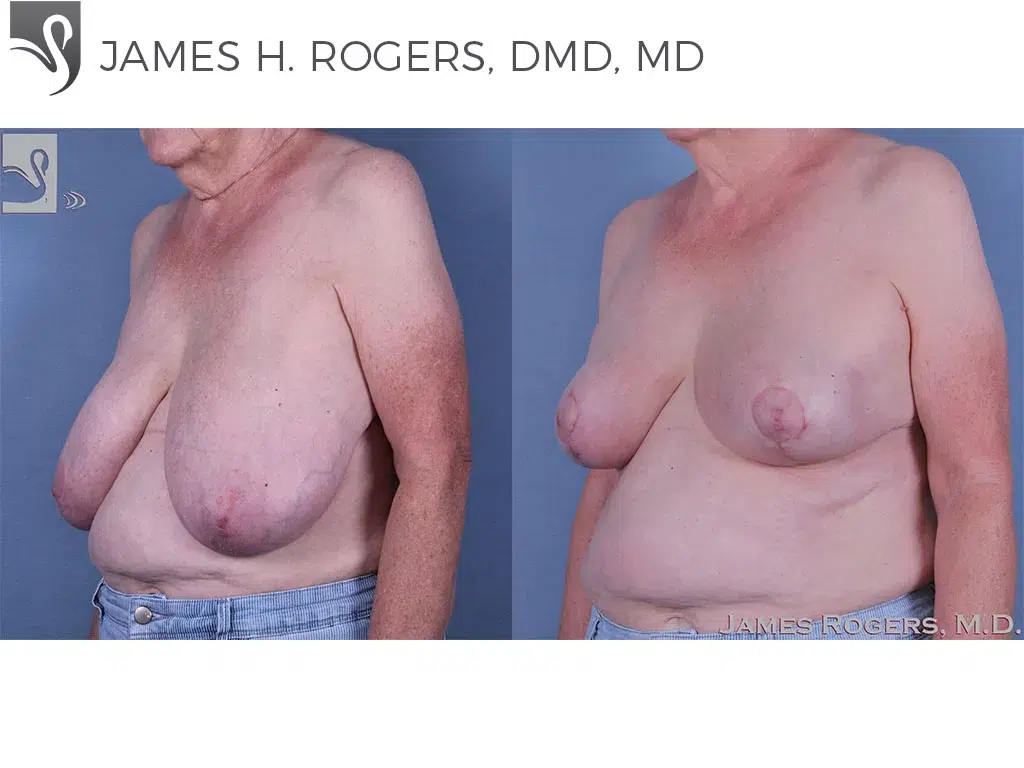Before and After Image: Female Breast Reduction Case #61041 - left-front-oblique