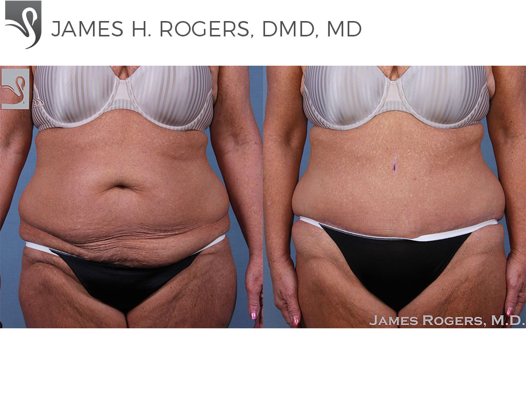 Before and After Image: Abdominoplasty (Tummy Tuck) Case #61208 - front
