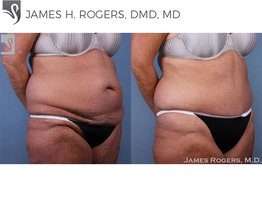 Before and After Image: Abdominoplasty (Tummy Tuck) Case #61208 - right-front-oblique