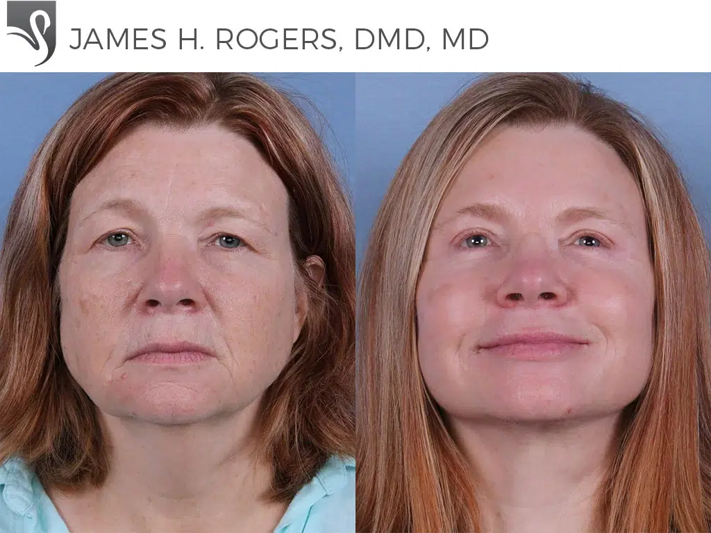 Before and After Image: Face Lift Case #61289 - front