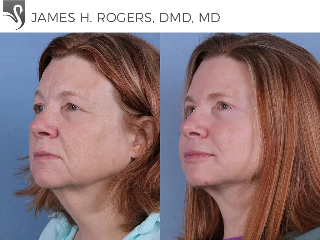 Before and After Image: Face Lift Case #61289 - left-front-oblique
