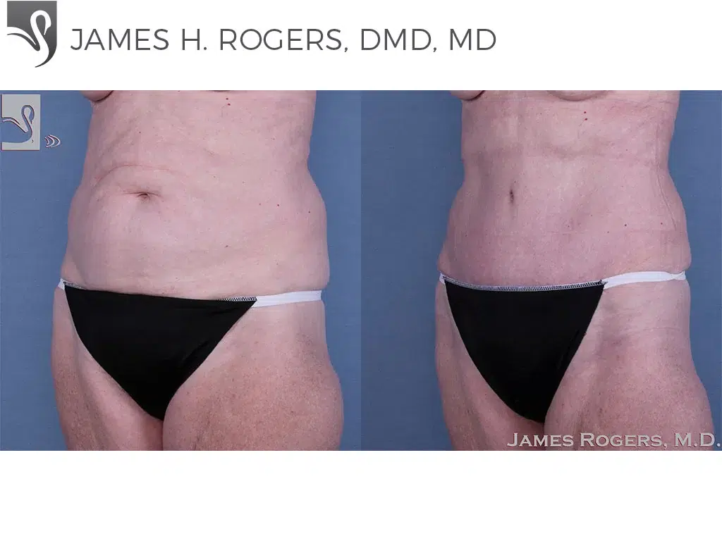 Before and After Image: Abdominoplasty (Tummy Tuck) Case #61412 - left-front-oblique