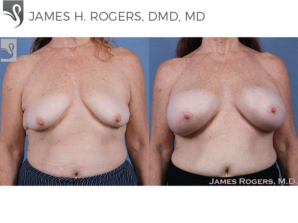 Before and After Image: Breast Augmentation Case #61426 - front