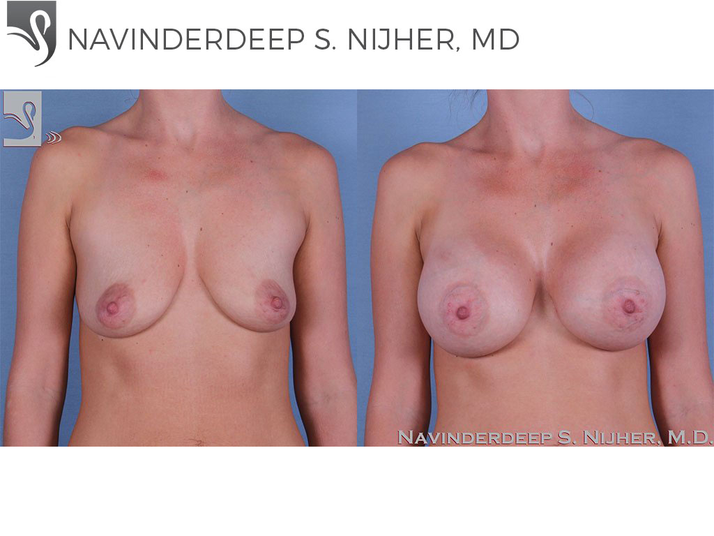 Before and After Image: Breast Augmentation Case #61523 - front