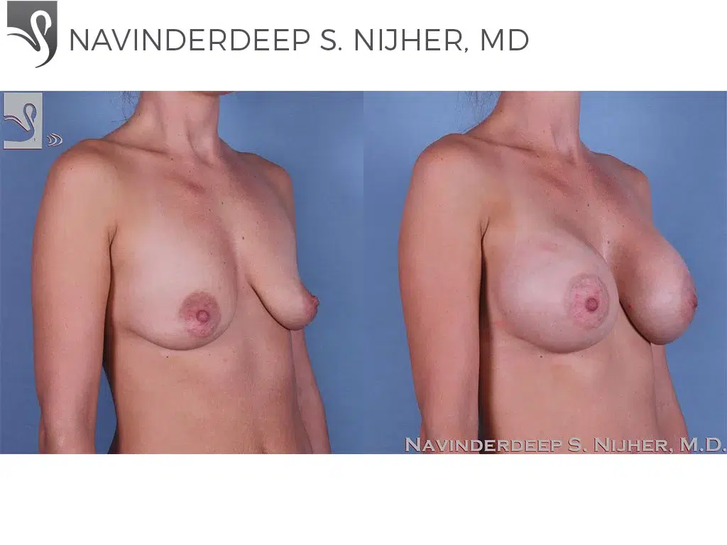 Before and After Image: Breast Augmentation Case #61523 - right-front-oblique