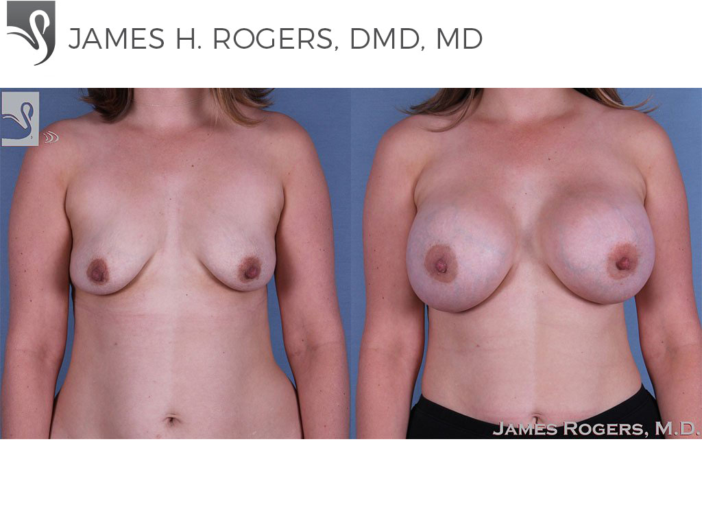 Before and After Image: Breast Augmentation Case #61529 - front