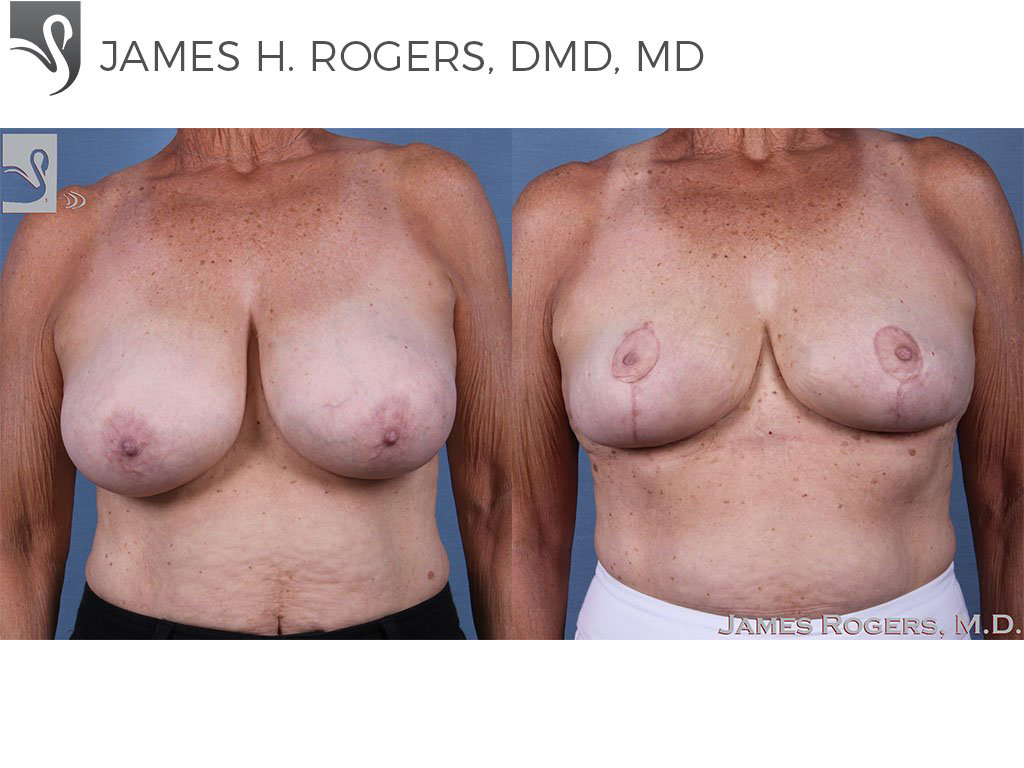 Before and After Image: Female Breast Reduction Case #61572 - front