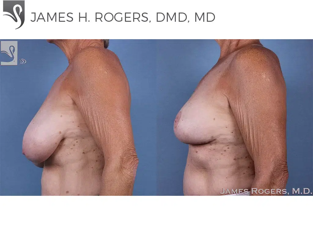 Before and After Image: Female Breast Reduction Case #61572 - left-side