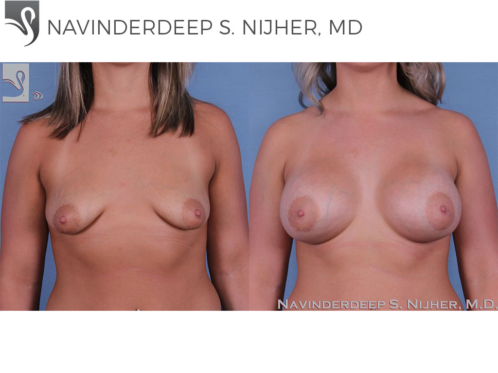 Before and After Image: Breast Augmentation Case #61617 - front