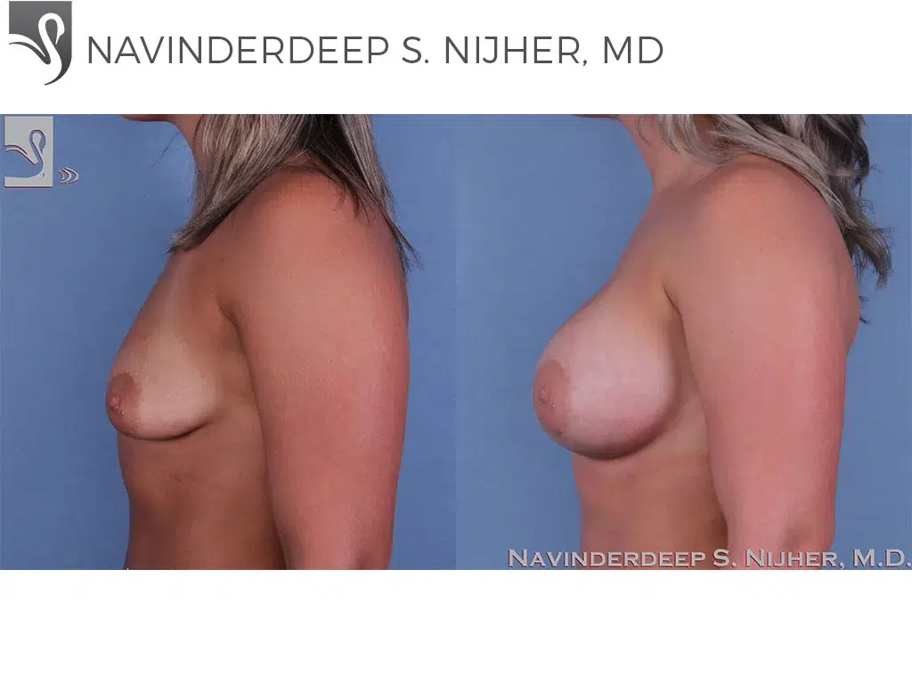 Before and After Image: Breast Augmentation Case #61617 - left-side