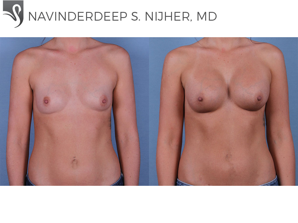 Before and After Image: Breast Augmentation Case #61620 - front