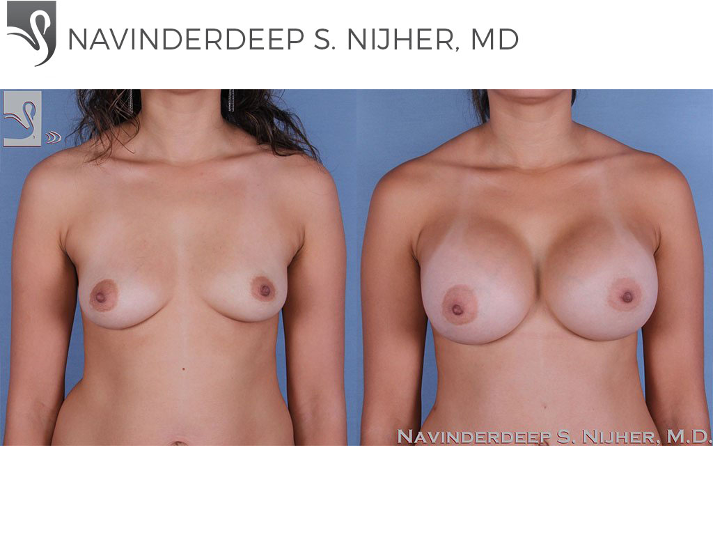 Before and After Image: Breast Augmentation Case #61677 - front
