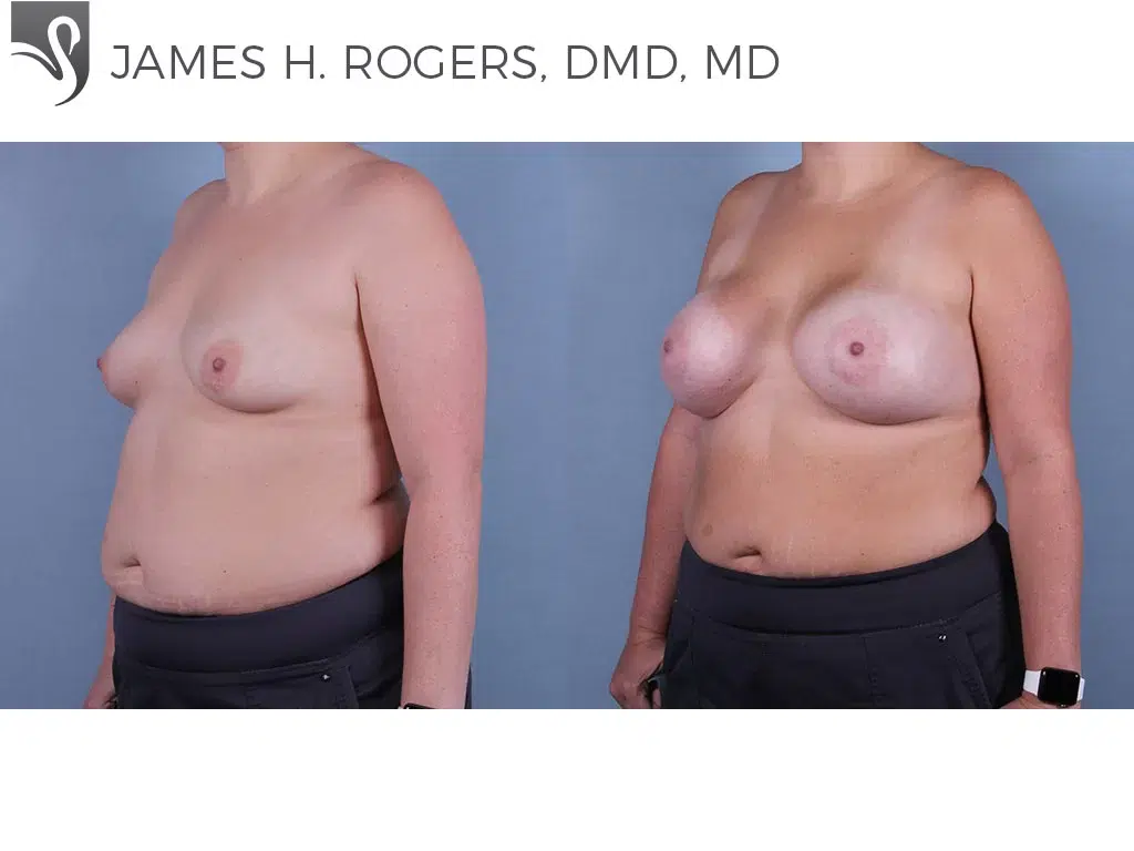 Before and After Image: Breast Augmentation Case #61814 - left-front-oblique