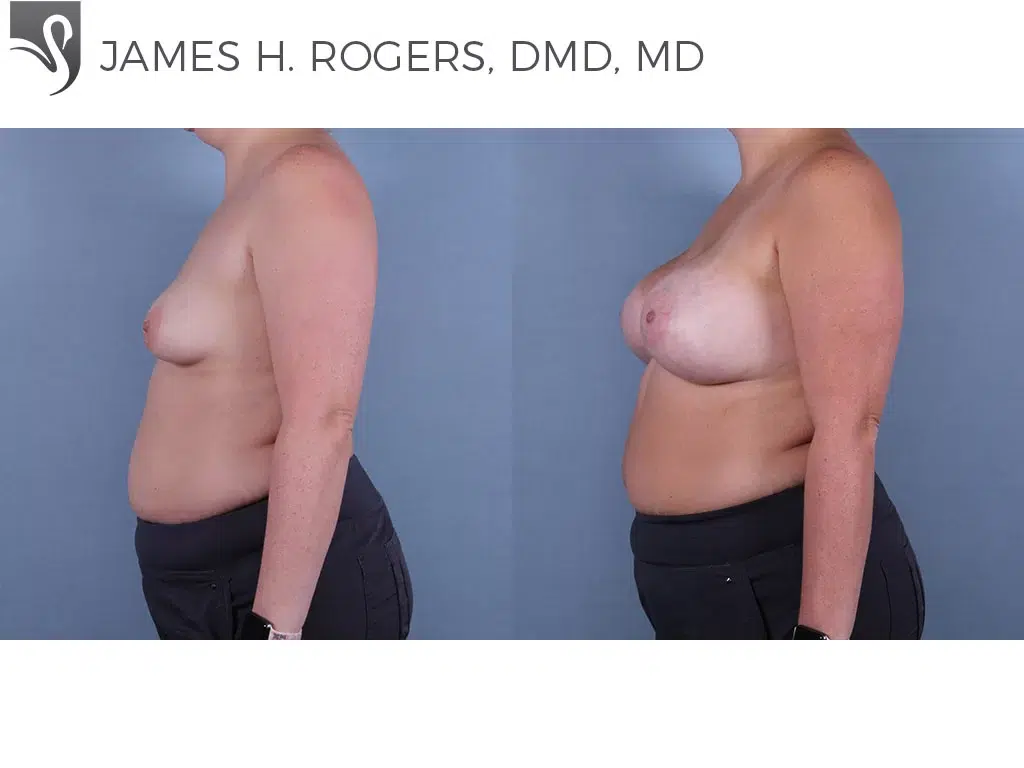 Before and After Image: Breast Augmentation Case #61814 - left-side