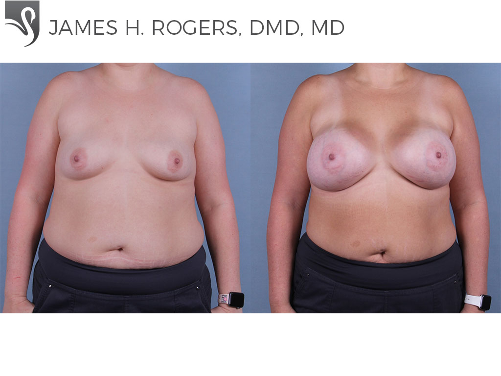 Before and After Image: Breast Augmentation Case #61814 - front