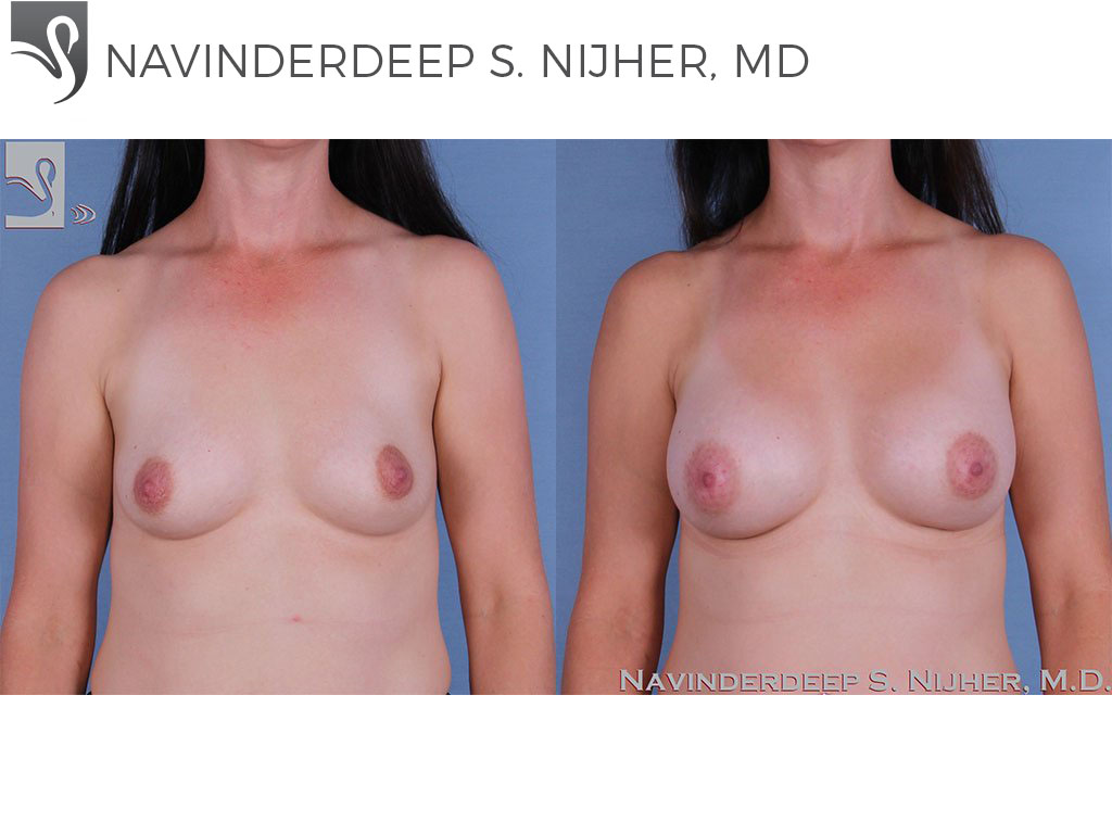 Before and After Image: Breast Augmentation Case #61852 - front