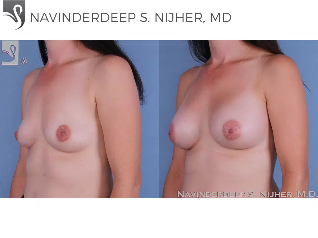 Before and After Image: Breast Augmentation Case #61852 - left-front-oblique