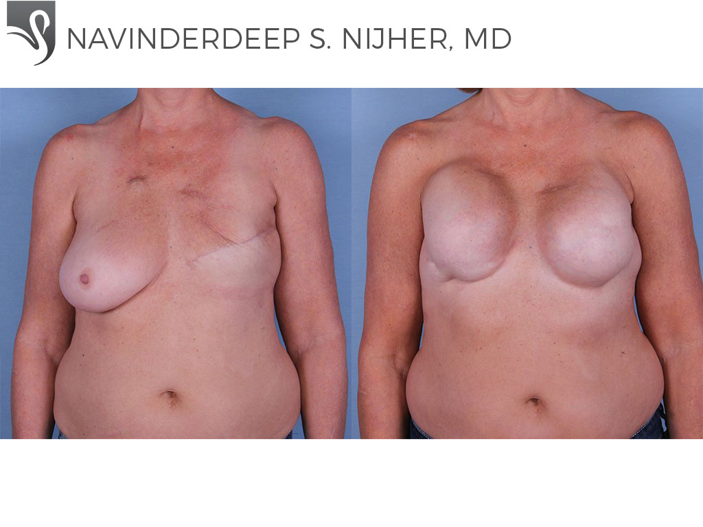 Before and After Image: Breast Reconstruction Case #61908 - front