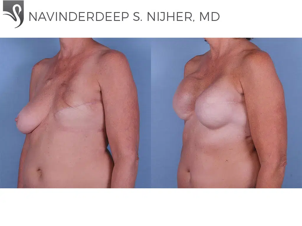 Before and After Image: Breast Reconstruction Case #61908 - left-front-oblique