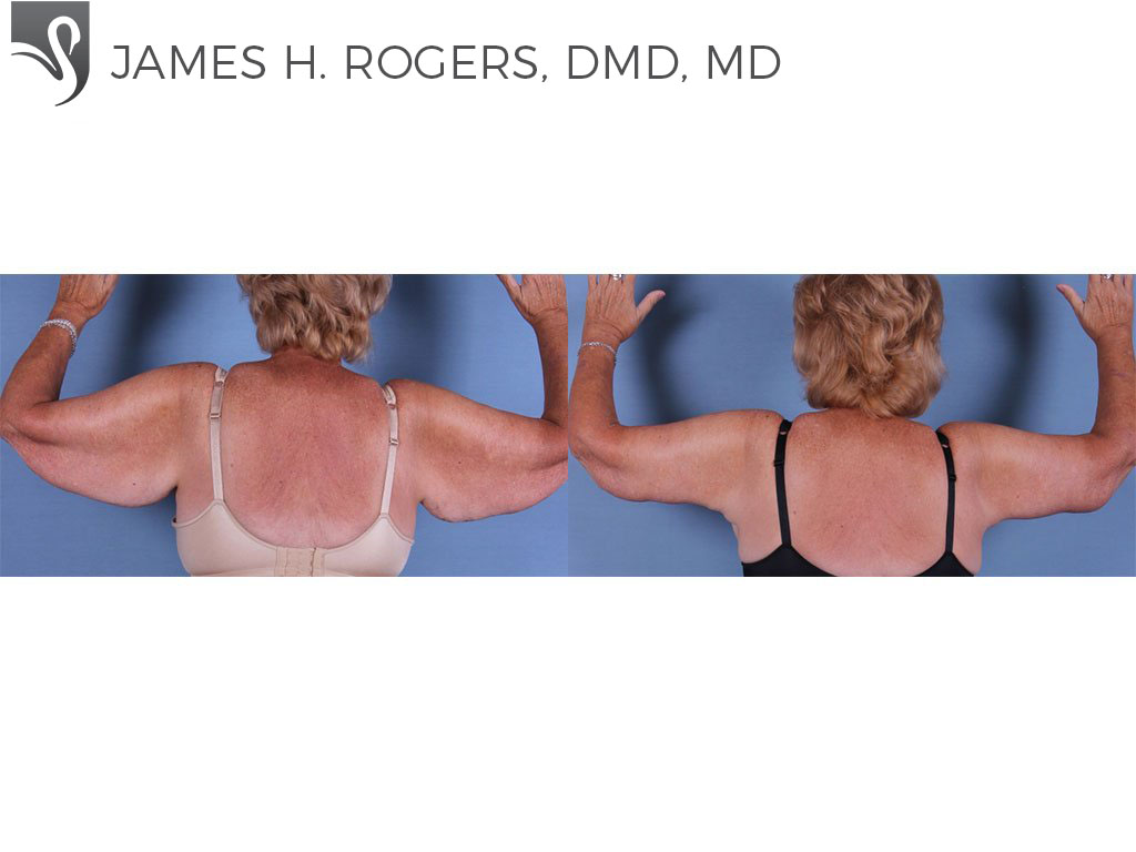 Before and After Image: Arm Lift Case #62058