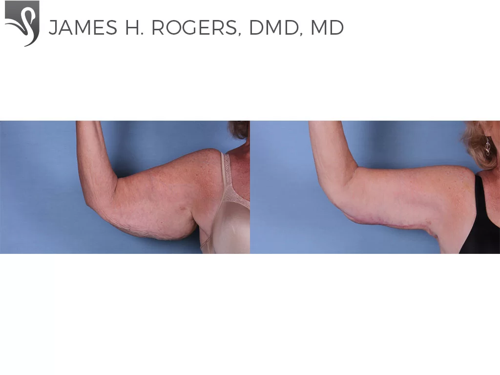 Before and After Image: Arm Lift Case #62058 - front