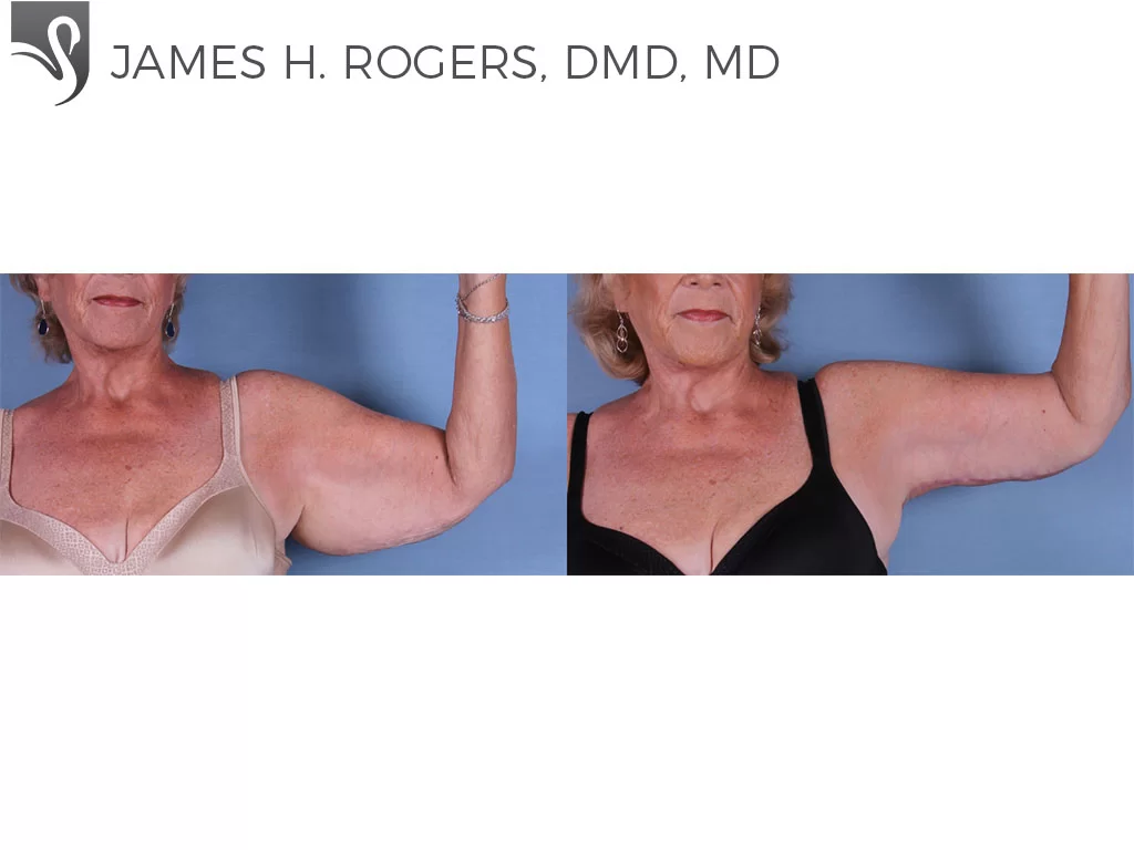 Before and After Image: Arm Lift Case #62058 - front