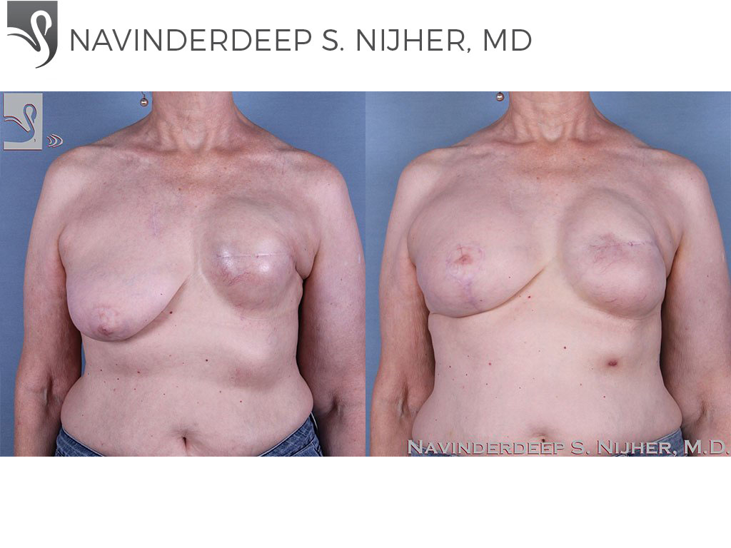 Before and After Image: Breast Reconstruction Case #62069 - front
