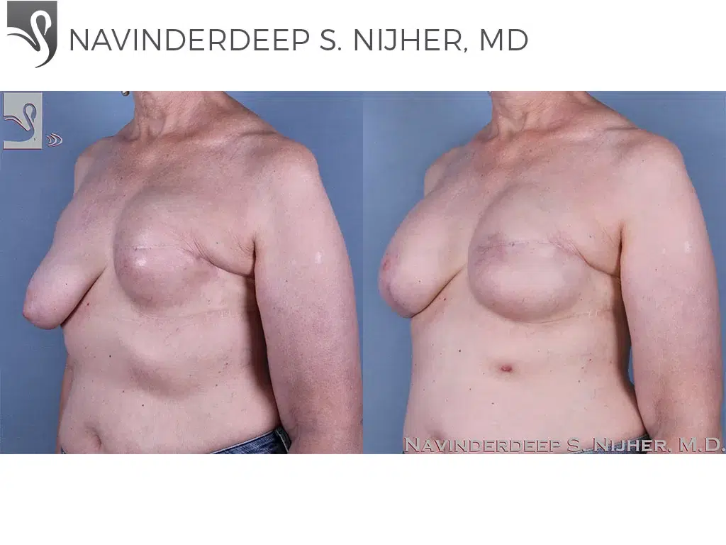 Before and After Image: Breast Reconstruction Case #62069 - left-front-oblique