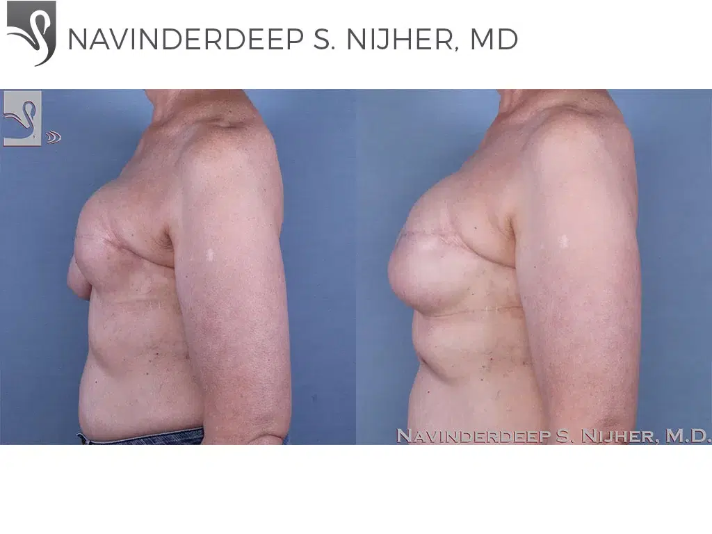Before and After Image: Breast Reconstruction Case #62069 - left-side