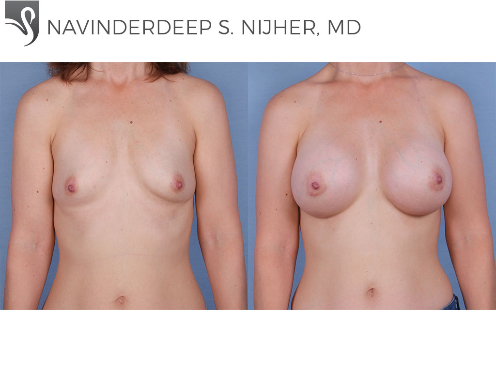 Before and After Image: Breast Augmentation Case #62201 - front