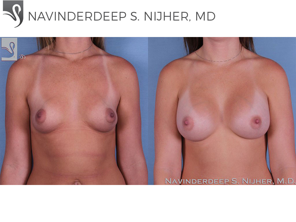 Before and After Image: Breast Augmentation Case #62246 - front