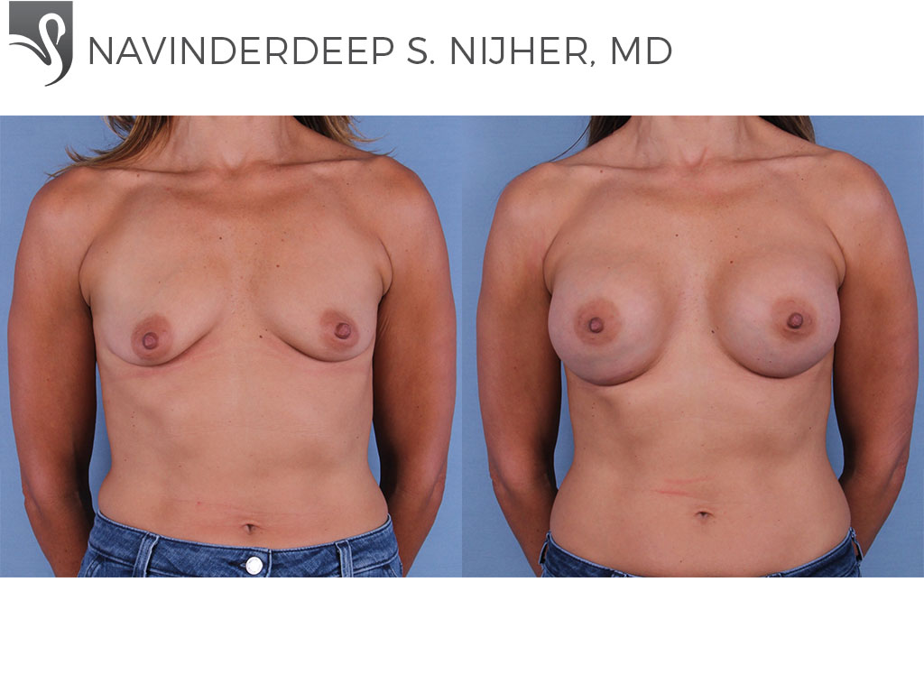Before and After Image: Breast Augmentation Case #62289 - front