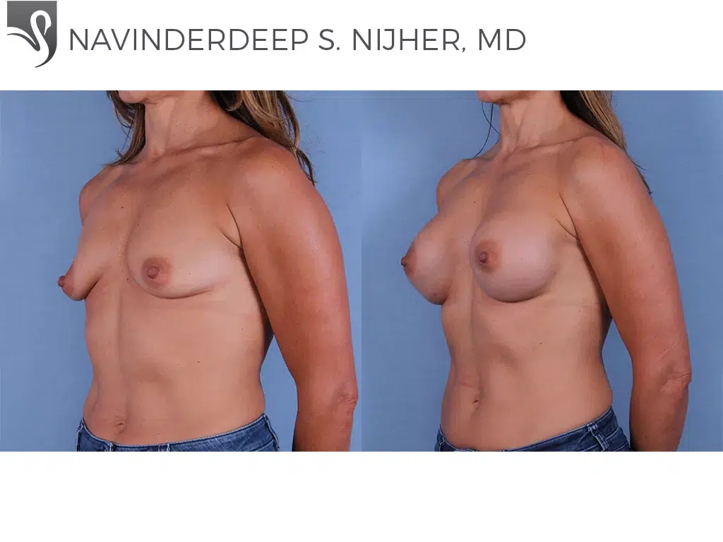 Before and After Image: Breast Augmentation Case #62289 - left-front-oblique