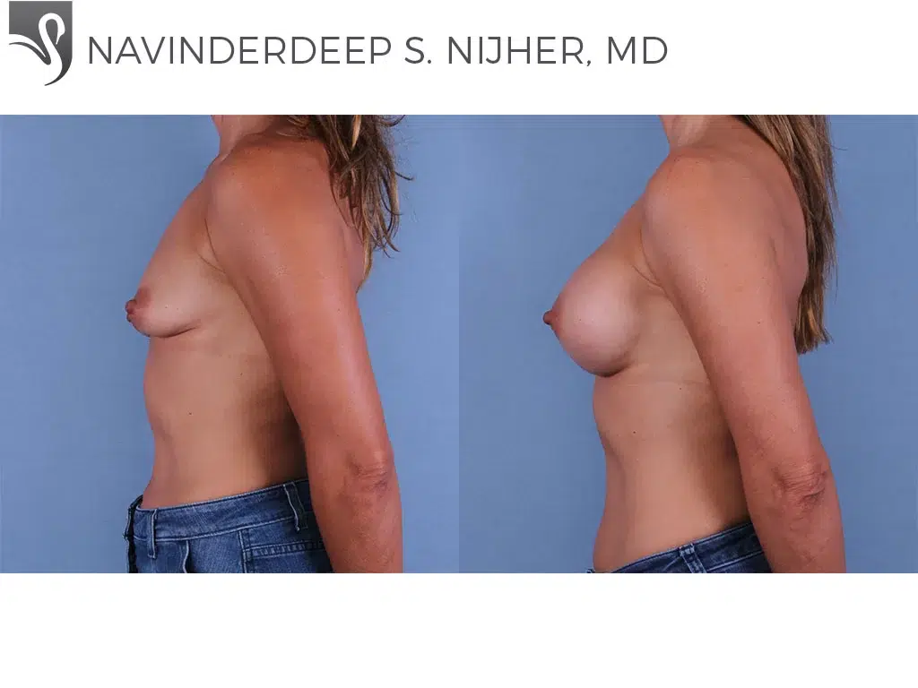 Before and After Image: Breast Augmentation Case #62289 - left-side