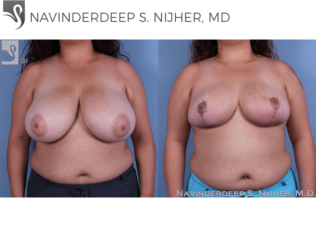 Before and After Image: Female Breast Reduction Case #62312 - front