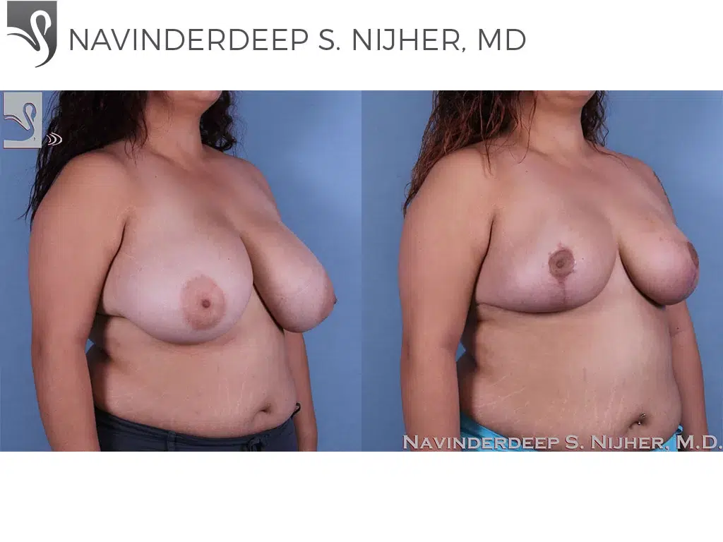 Before and After Image: Female Breast Reduction Case #62312 - right-front-oblique