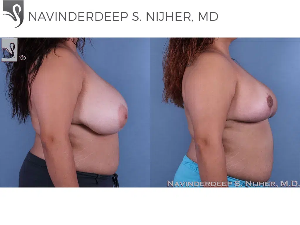 Before and After Image: Female Breast Reduction Case #62312 - right-side