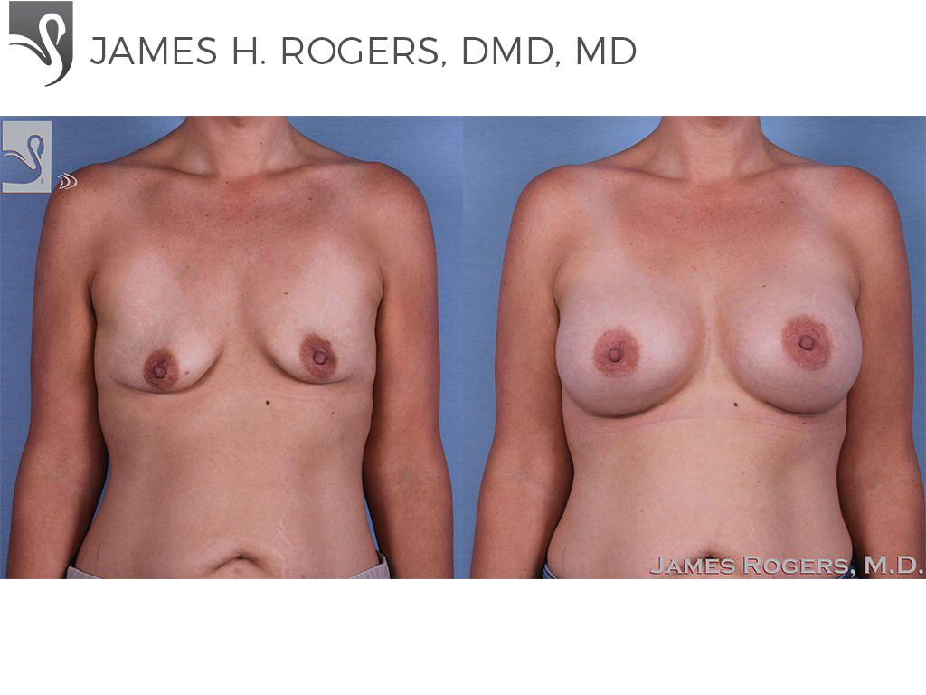 Before and After Image: Breast Augmentation Case #62324 - front