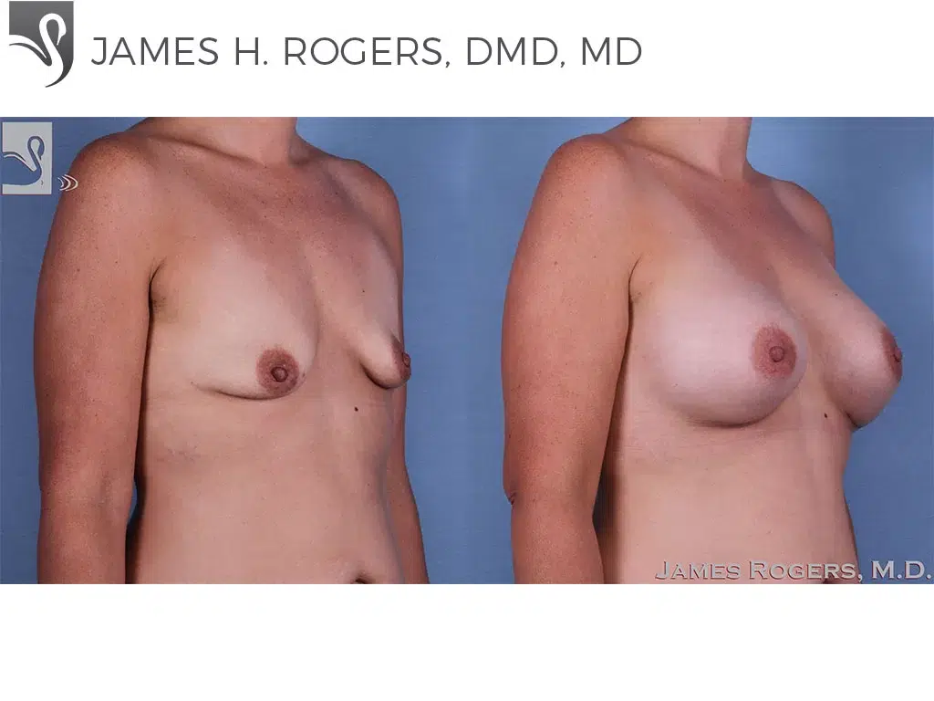 Before and After Image: Breast Augmentation Case #62324 - right-front-oblique
