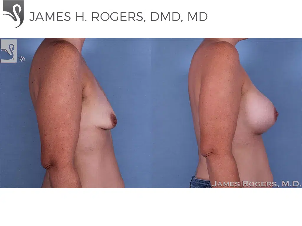 Before and After Image: Breast Augmentation Case #62324 - right-side
