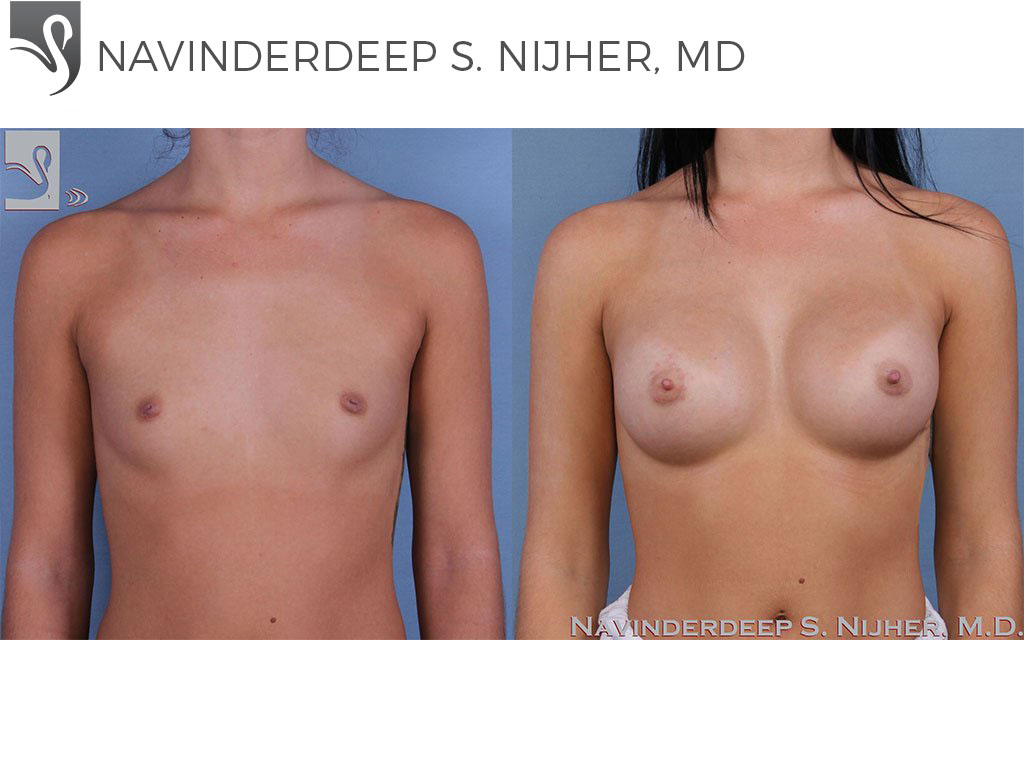 Before and After Image: Breast Augmentation Case #62362 - front