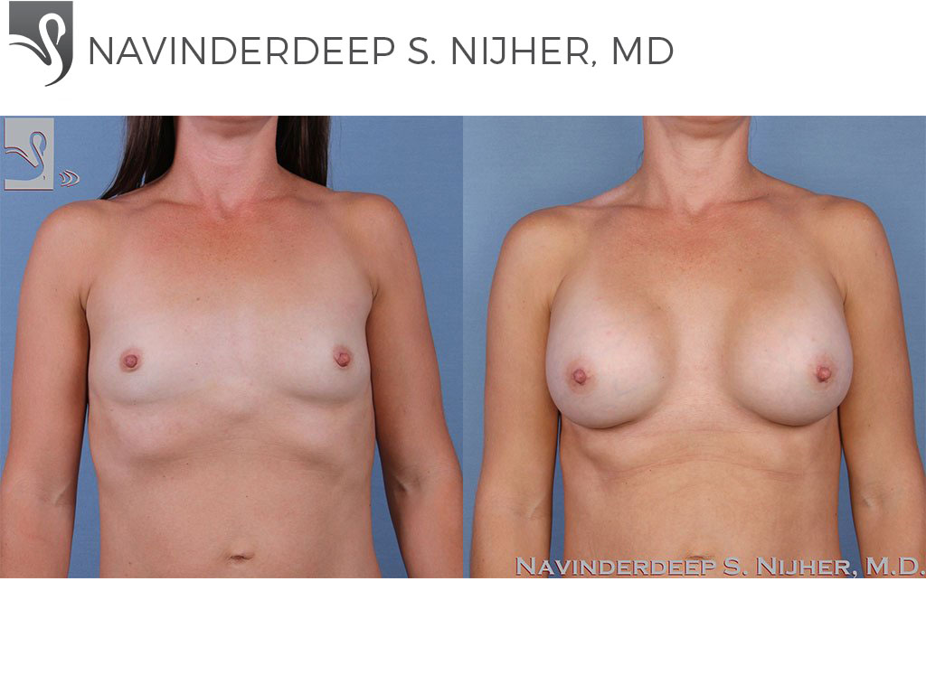Before and After Image: Breast Augmentation Case #62441 - front