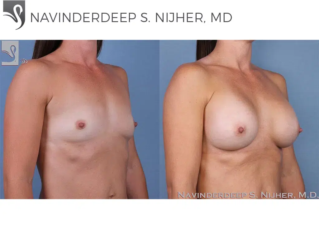 Before and After Image: Breast Augmentation Case #62441 - right-front-oblique