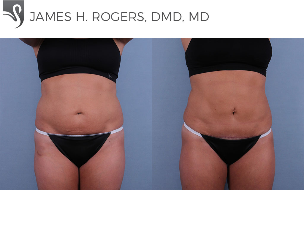 Before and After Image: Abdominoplasty (Tummy Tuck) Case #62459 - front