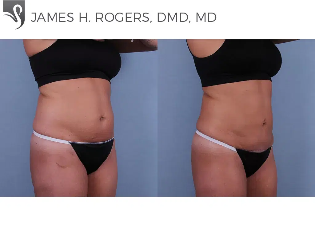 Before and After Image: Abdominoplasty (Tummy Tuck) Case #62459 - right-front-oblique