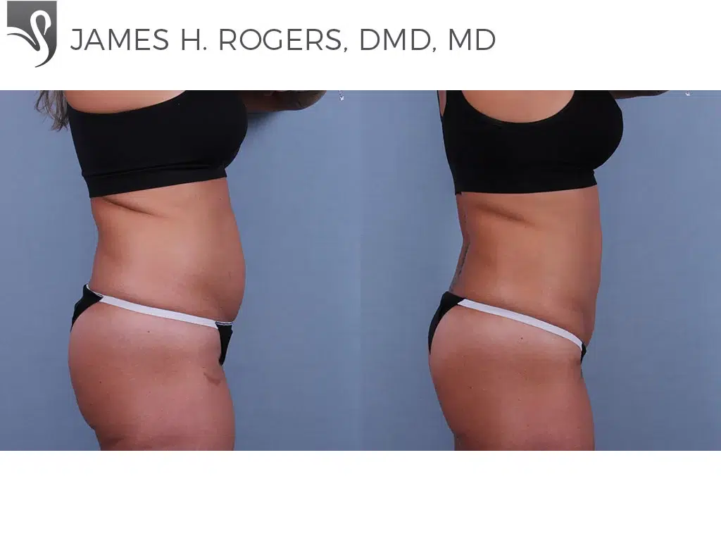 Before and After Image: Abdominoplasty (Tummy Tuck) Case #62459 - right-side