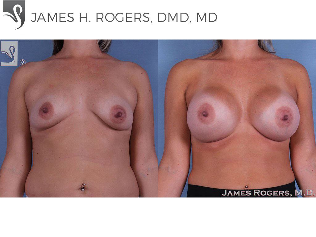 Before and After Image: Breast Augmentation Case #62459 - front