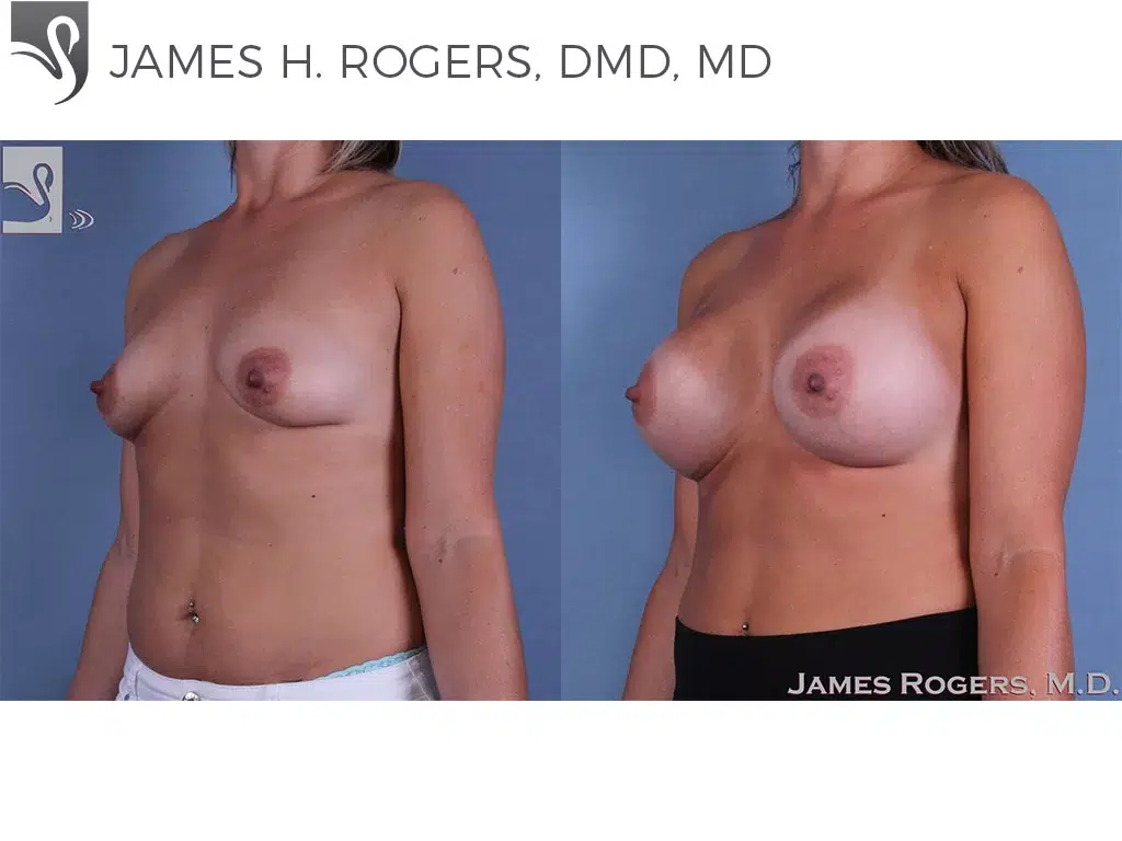 Before and After Image: Breast Augmentation Case #62459 - left-front-oblique
