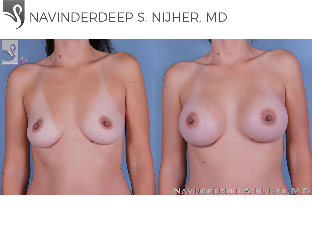 Before and After Image: Breast Augmentation Case #62465 - front