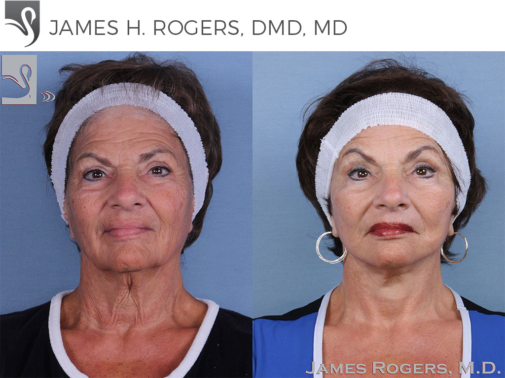 Before and After Image: Face Lift Case #62473 - front